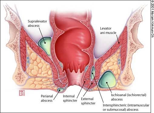 Laser Treatment for Piles