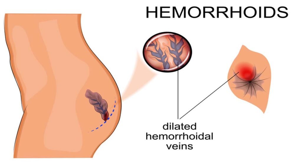 Laser Surgery for Piles in Surat